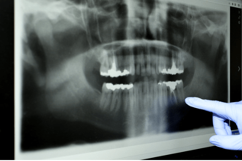 A gloved hand points at a dental X-ray showing a panoramic view of teeth. The image displays several teeth with fillings or dental work. The background is a digital screen where the X-ray is displayed.