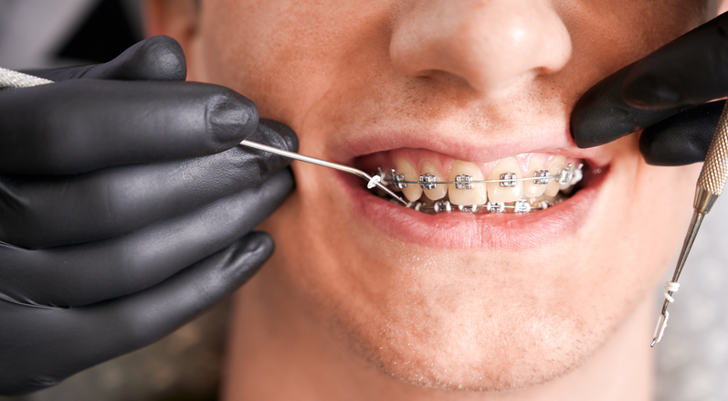 A close-up of a person’s mouth receiving orthodontic treatment. The person has braces, and a dentist wearing black gloves uses dental tools to adjust the braces while the patient is slightly smiling.