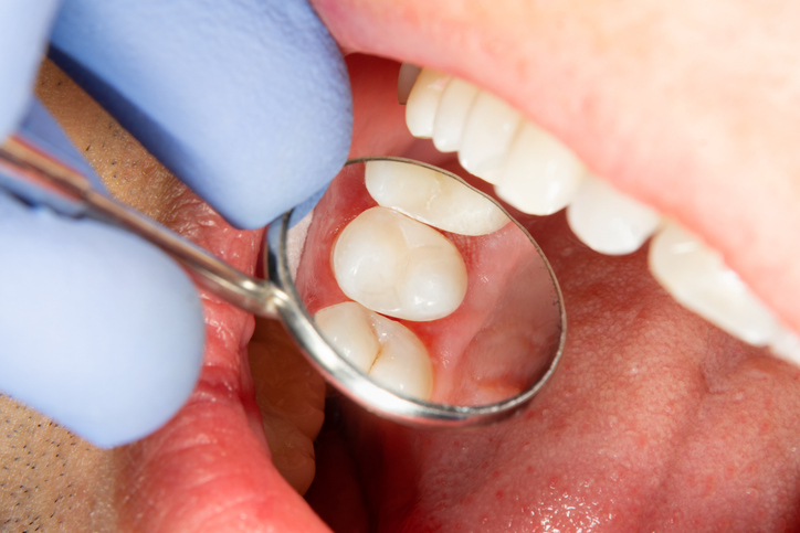 A close-up of a person's open mouth during a dental exam, showing a dentist’s gloved hand holding a dental mirror reflecting molar teeth and gums being checked for sealant application.