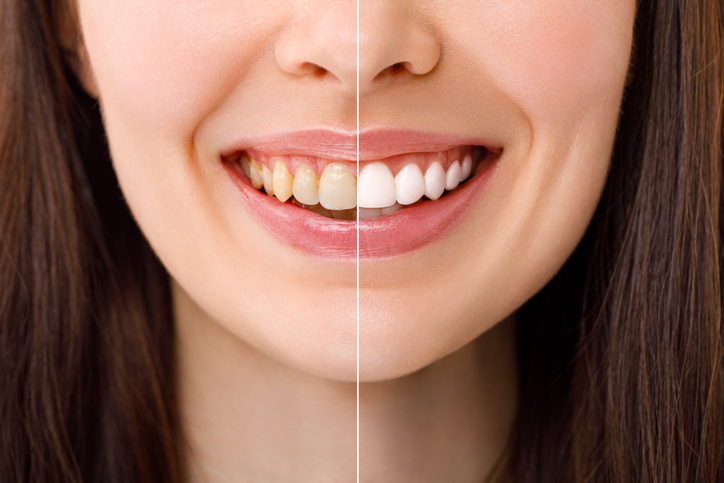 A close-up of a woman's mouth, split in half vertically. The left side has yellow, stained teeth, while the right side features clean, white teeth, highlighting the dramatic effects of veneers and teeth whitening.