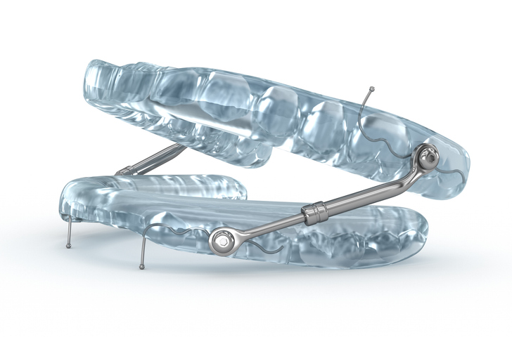 A transparent snoring appliance with metal hinges and rods, designed to fit over the upper and lower teeth, used for orthodontic or sleep apnea treatment, shown on a white background.