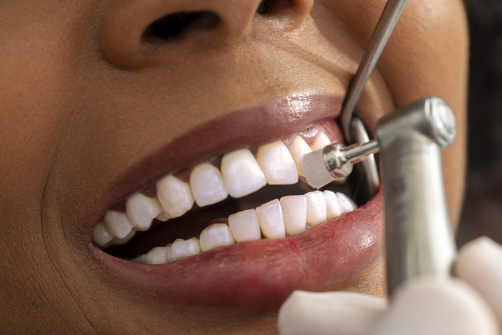 Close-up of a person’s mouth during a teeth cleaning procedure, showing a dentist using a polishing tool on their teeth. The person’s lips are slightly parted, revealing clean white teeth.